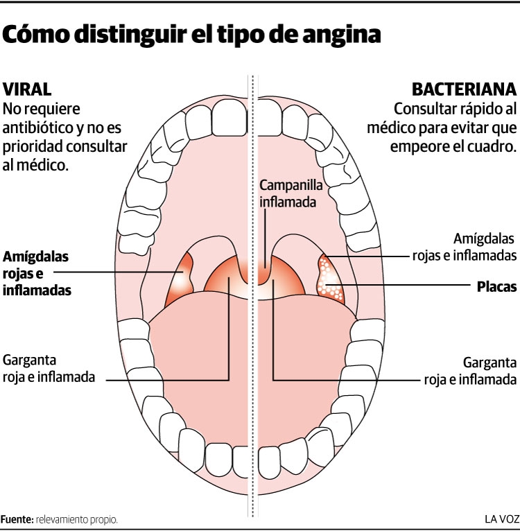 0_angina-bacteriana-1.jpg